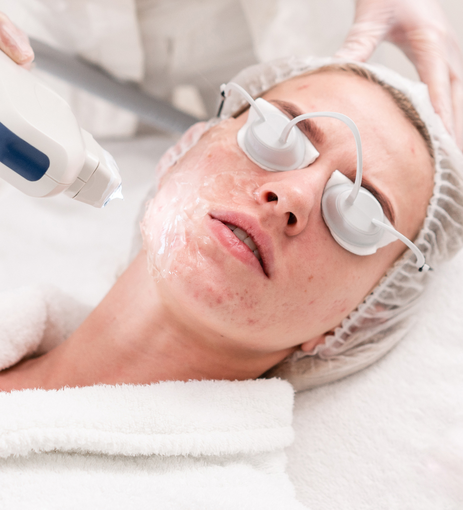 Laser Acne Treatment