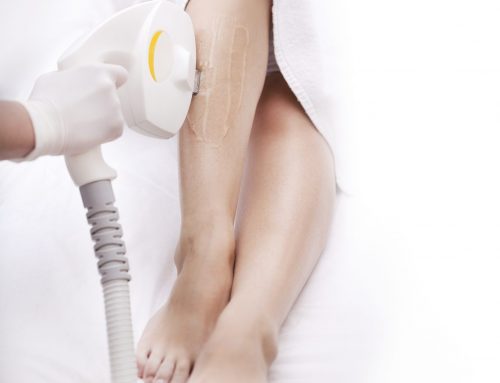 Do you need IPL hair removal?